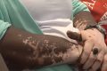 Les membres supérieurs d’une personne atteinte de vitiligo. © Gabonreview